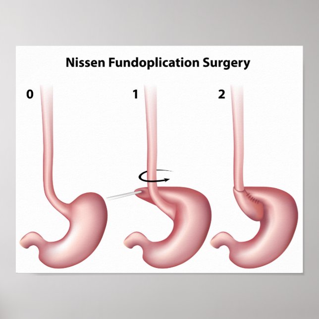 Nissen Poster de chirurgie de l'estomac de réplica (Devant)