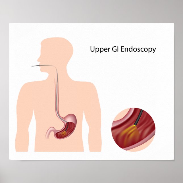 Ober GI Endoskopie Poster (Vorne)