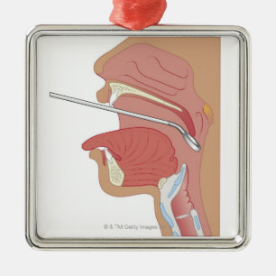 Ornement Métallique Laryngoscopie de miroir