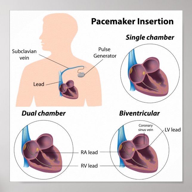 Pacemaker Insertion Operation Poster (Vorne)