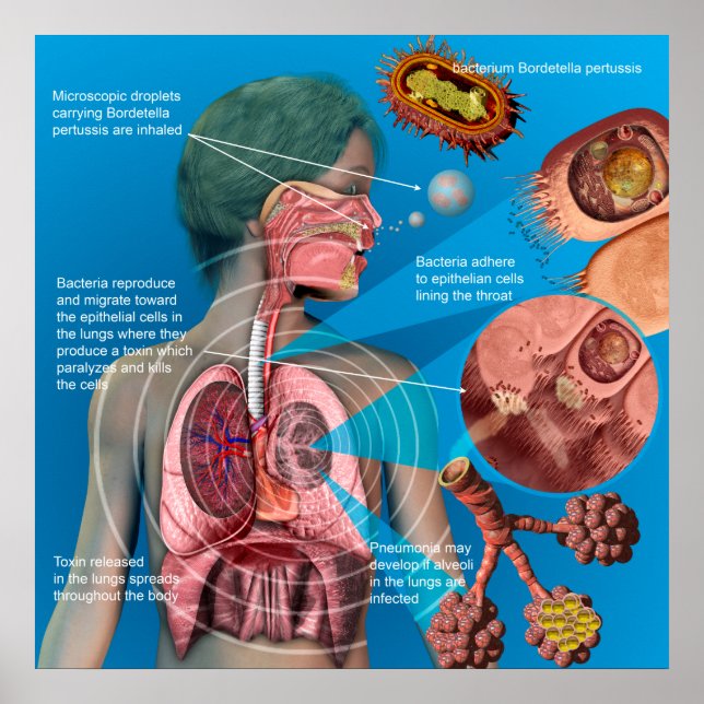 Pertussis (husten)-Poster Poster (Vorne)