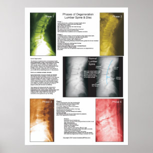 Phasen-lumbales spinales Degenerations-Plakat Poster