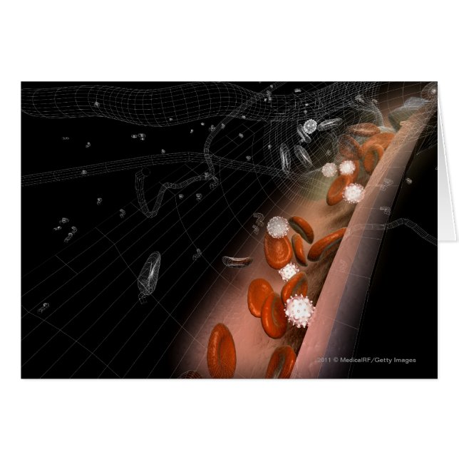 Plaque dans les artères (Devant horizontal)