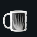 Polydactyl Handröntgenstrahl Kaffeetasse<br><div class="desc">Zwei Röntgenstrahlen von polydactyl Hände können Sie schnell haben Sprichwort,  ",  wieviele Finger."</div>