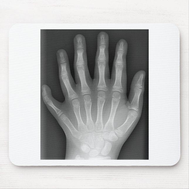 Polydaktylie, sechs fingrige Hand, Röntgenstrahl, Mousepad (Vorne)