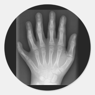 Polydaktylie, sechs fingrige Hand, Röntgenstrahl, Runder Aufkleber