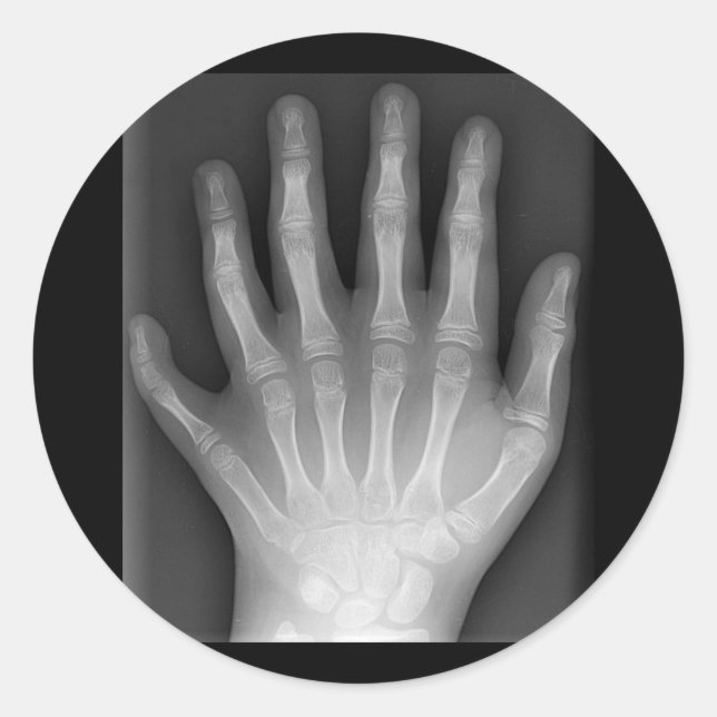 Polydaktylie, Sechs gefederte Hand, X-Ray, Seltenh Runder Aufkleber (Vorderseite)
