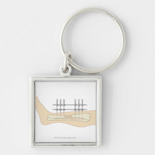 Porte-clés Fixator externe