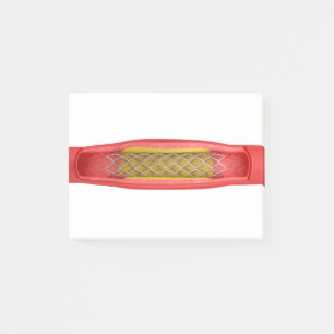 Post-it® Angioplastie avec placement d'endoprothèse