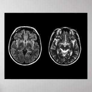 Poster Analyse Mri du cerveau