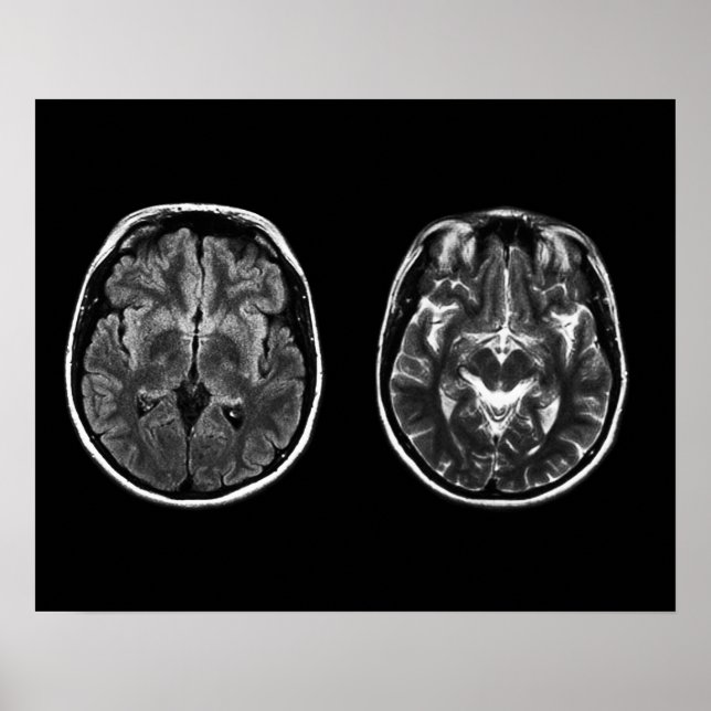 Poster Analyse Mri du cerveau (Devant)