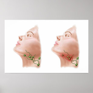 Poster Anatomie des ganglions lymphatiques gonflés