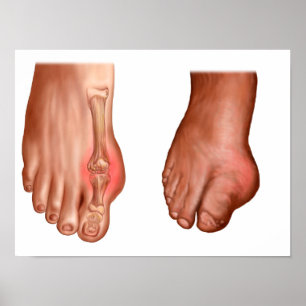 Poster Anatomie D'Un Pied Gonflé