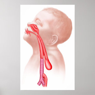 Poster Anatomie d'une fistule Tracheoesophageal