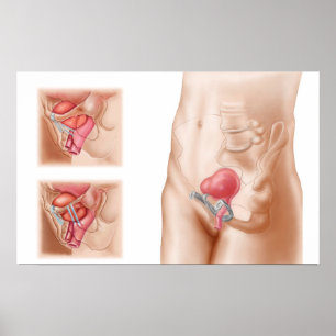 Poster Anatomy Of Bladder Suspension Procedure