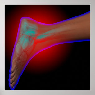 Poster Ankle Pain