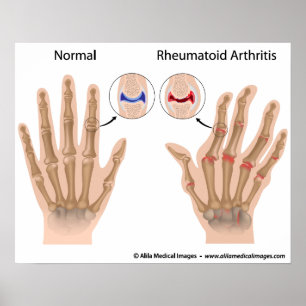 Poster Arthrite rhumatoïde des articulations du doigt, di