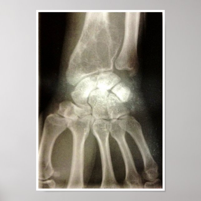 Poster Carpals Xray (Devant)