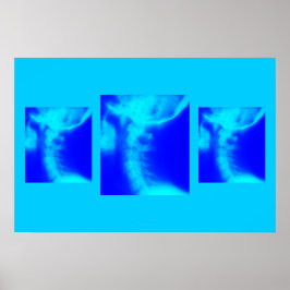 Poster chiropratique : Blues cervicales latéraux