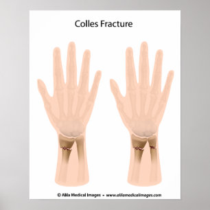 Poster Colles fracture, medical illustration.