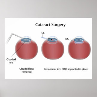 Poster de chirurgie cataracte