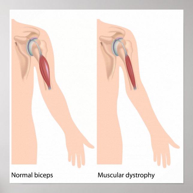 Poster de la dystrophie musculaire (Devant)