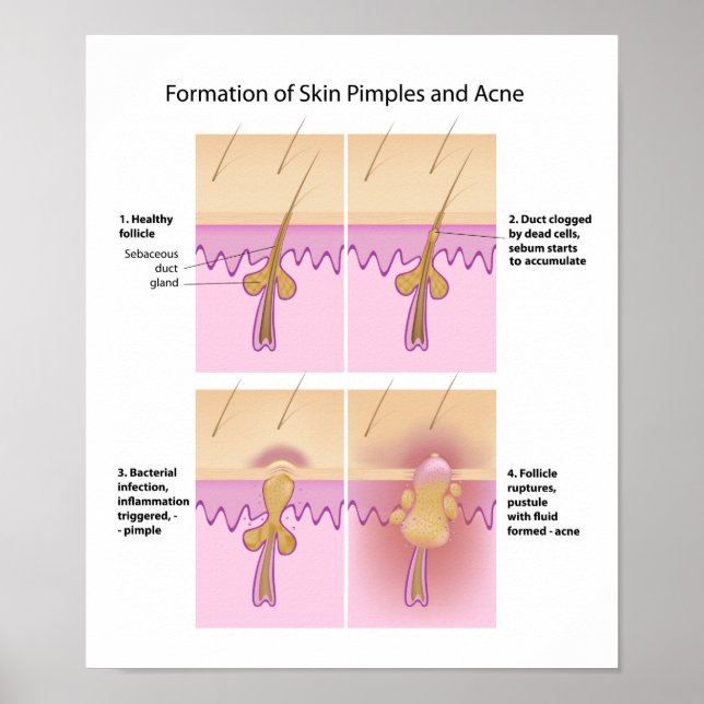 Poster de l'acné et des boutons de peau (Devant)