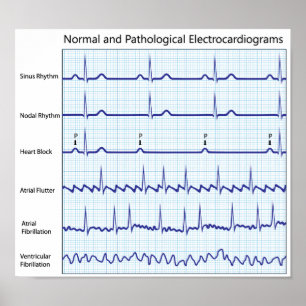 Poster d'ecg normal et pathologique