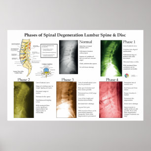 Poster Dégénérescence de la colonne lombaire Chiropratiqu