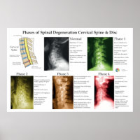 Dégénérescence de la colonne vertébrale cervicale 