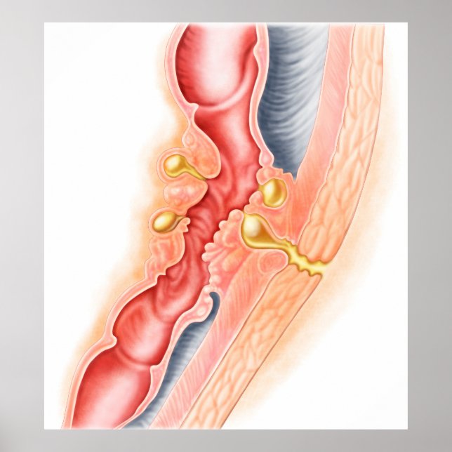 Poster Développement De La Fistule (Devant)