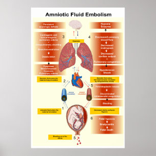 Poster Diagramme d'un embolisme AFE de liquide amniotique