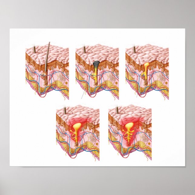 Poster Différents Types D'Acné (Devant)