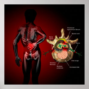 Poster Douleur du dos