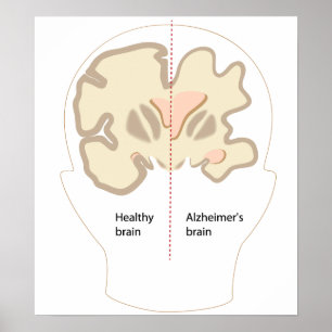 Poster du cerveau de la maladie d'Alzheimer