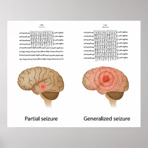 Poster EEG dans l'épilepsie partielle et généralisée Post