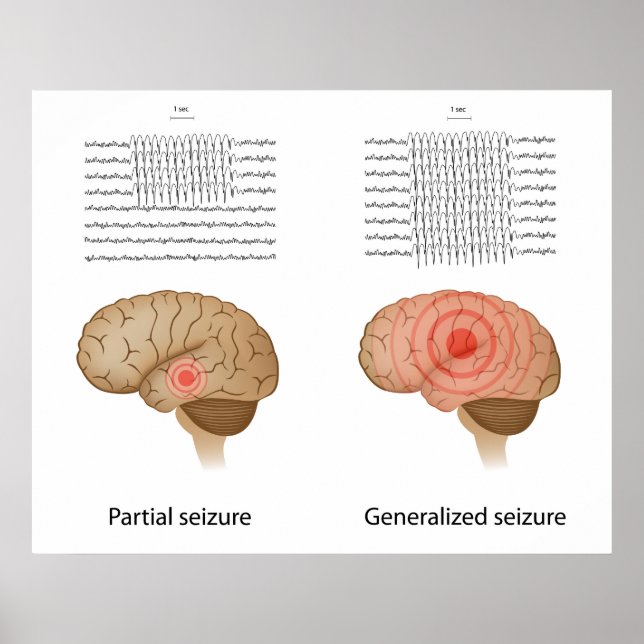 Poster EEG dans l'épilepsie partielle et généralisée Post (Devant)