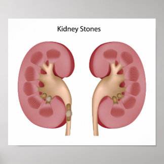 Poster en pierre de Kidney