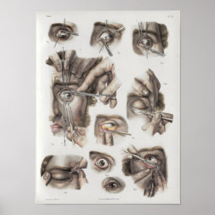 Poster Eye Surgery Technique Vintage Anatomy Print