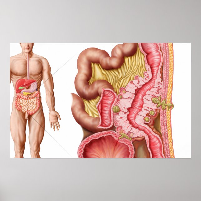 Poster Illustration De La Diverticulose Dans Le Colon (Devant)