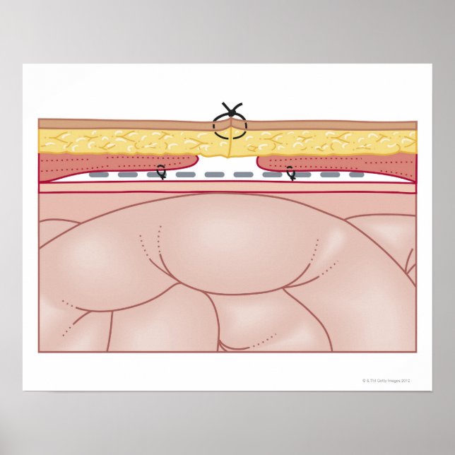 Poster Illustration d'une hernie (Devant)
