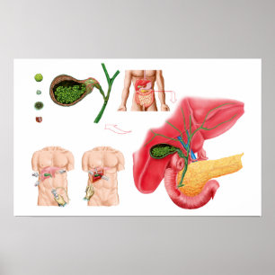 Poster Illustration montrant la cholécystectomie