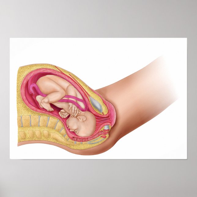 Poster Illustration Montrant La Livraison Du Foetus 2 (Devant)