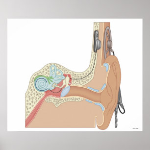 Poster Implants cochléaires