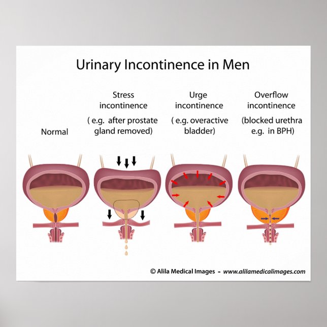 Poster Incontinence urinaire masculine (Devant)