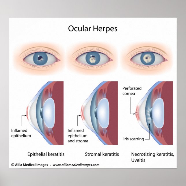 Poster Infection à l'herpès oculaire, diagrammes étiqueté (Devant)