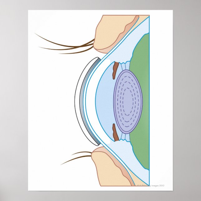 Poster Lentilles de contact souples (Devant)