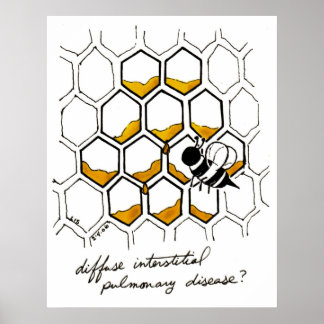 Poster Maladie pulmonaire interstitielle diffuse