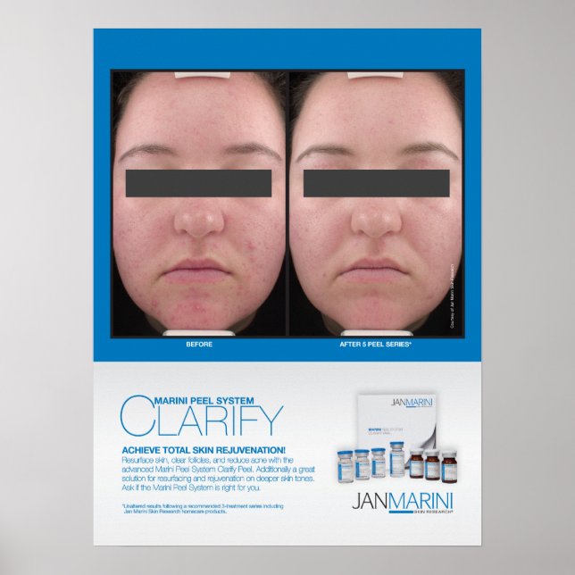 Poster Marini Peel Clarify Résultats 18x24" (Devant)