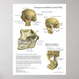 Poster Médicale de l'anatomie du syndrome de l'art